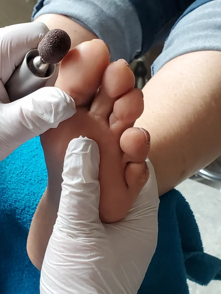 Nahaufnahme einer Fußpflege Behandlung, Hornhaut wird mit einem elektrischen Fräser bearbeitet, Hände tragen Handschuhe.