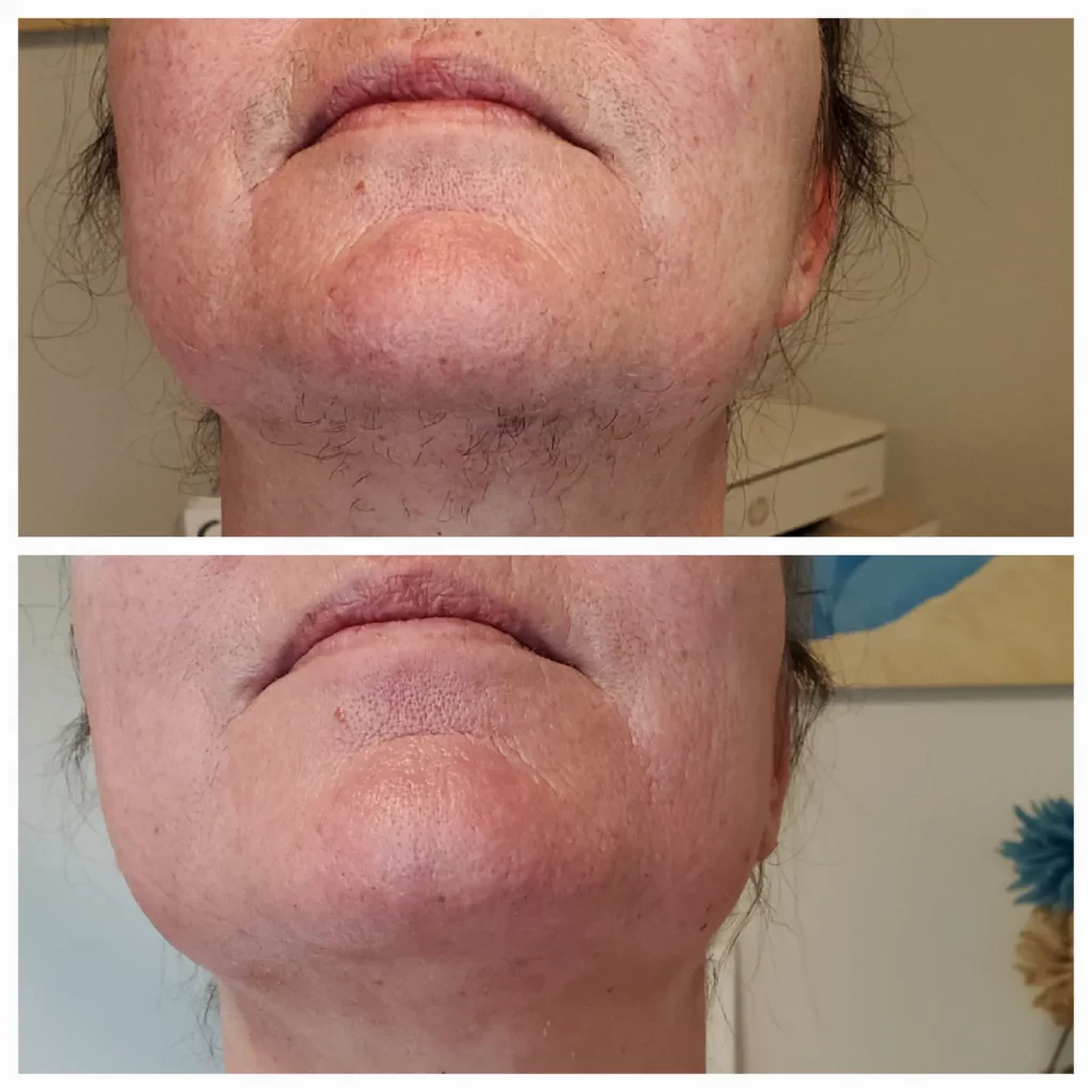 Vorher nachher Vergleich des Kinnbereichs nach einer Heisswachs Behandlung.